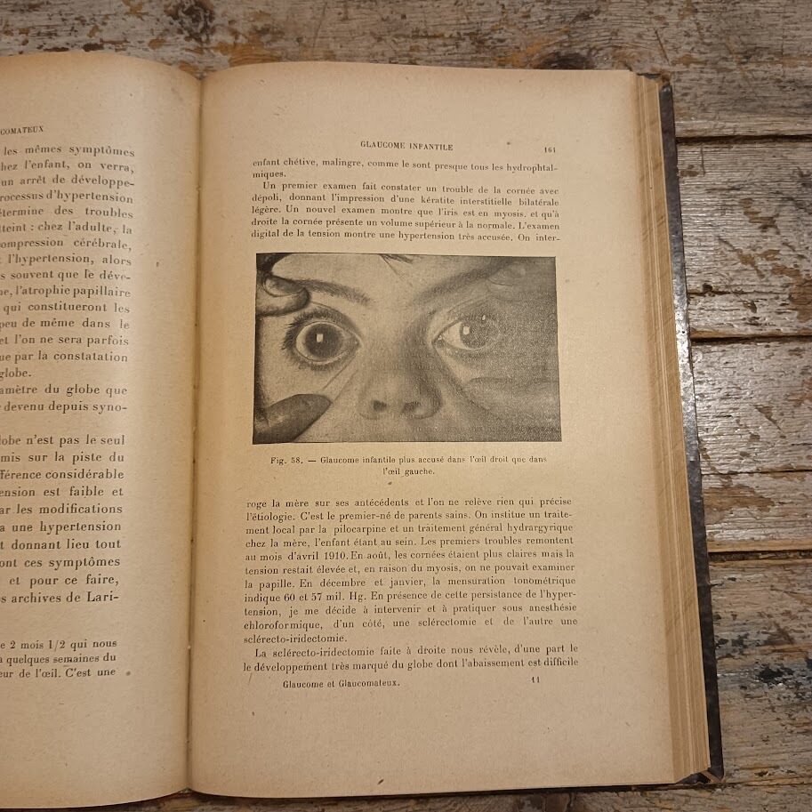 Glaucome et glaucomateux - immagine 5