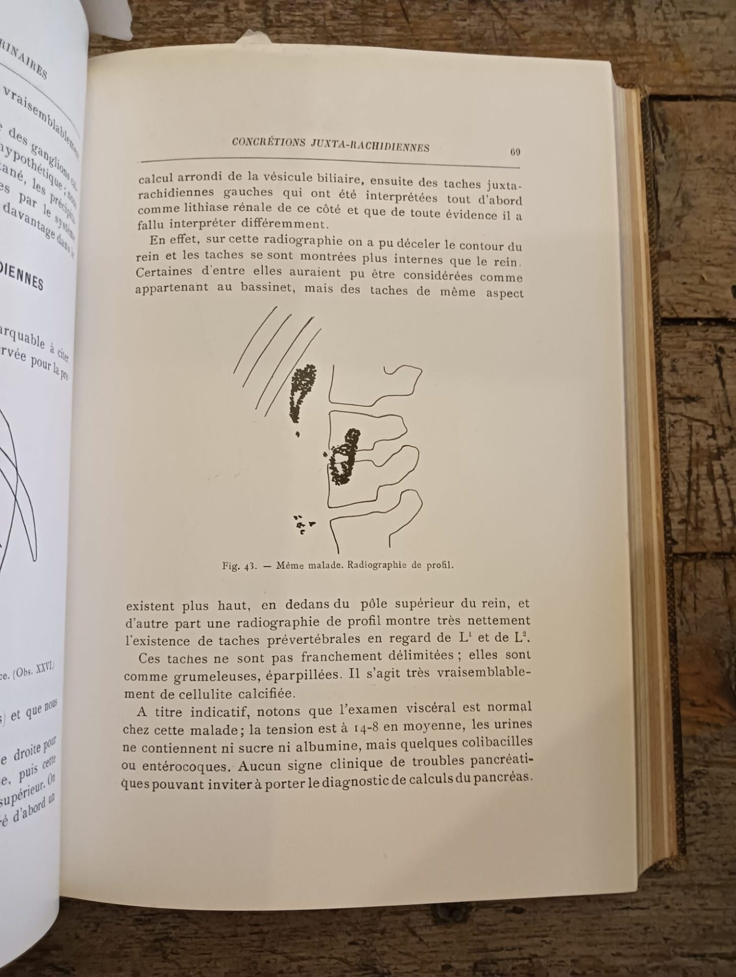 Quelques vérités premières en urologie - Quelques formes cliniques de lithiase urinaire - Les erreurs et les fautes en urologie - Les calculs de l'uretere - immagine 7